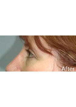 After Image: Eyelid Lift - other