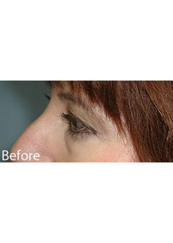 Before Image: Eyelid Lift - other