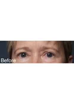 Before Image: Eyelid Lift - other