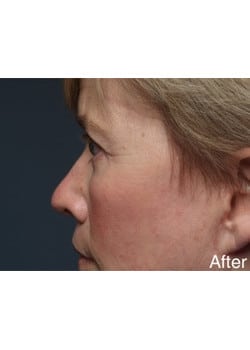 After Image: Eyelid Lift - other