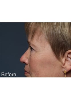 Before Image: Eyelid Lift - other