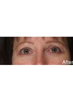 After Image: Eyelid Lift
