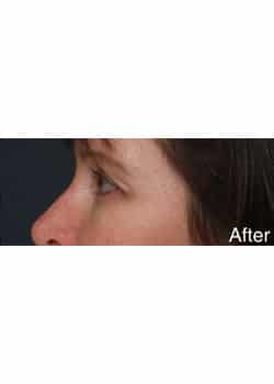 Eyelid Lift