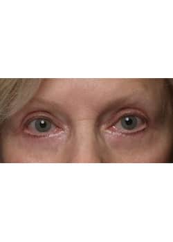 After Image: Eyelid Lift - other