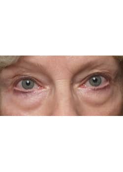 Before Image: Eyelid Lift - other