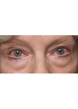 Eyelid Lift