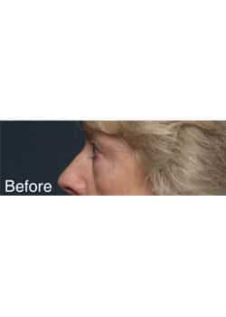 Before Image: Eyelid Lift - other