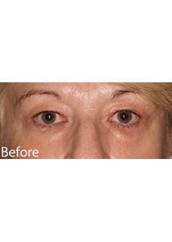 Before Image: Eyelid Lift - other