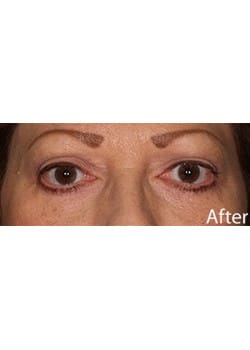 After Image: Eyelid Lift - other