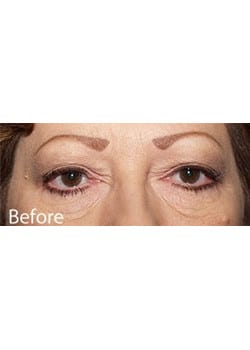 Before Image: Eyelid Lift - other