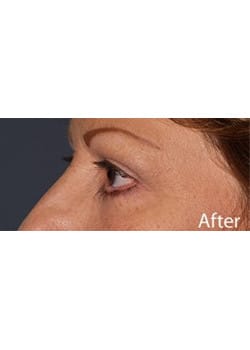 After Image: Eyelid Lift - left-front-oblique