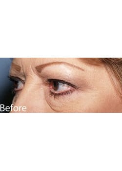 Before Image: Eyelid Lift - left-front-oblique