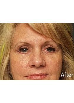 After Image: Eyelid Lift - front