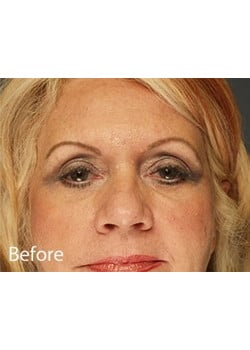 Before Image: Eyelid Lift - front
