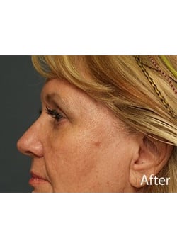 After Image: Eyelid Lift - other