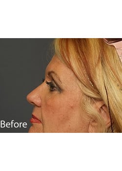 Before Image: Eyelid Lift - other