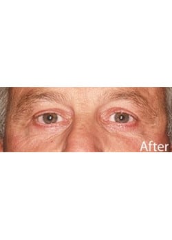 After Image: Eyelid Lift - other