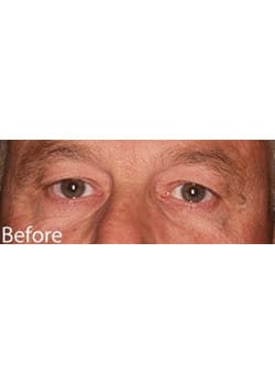 Before Image: Eyelid Lift - other