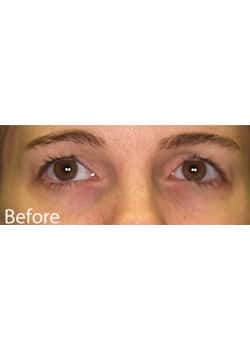Before Image: Eyelid Lift - other