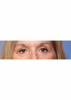 After Image: Eyelid Lift - other
