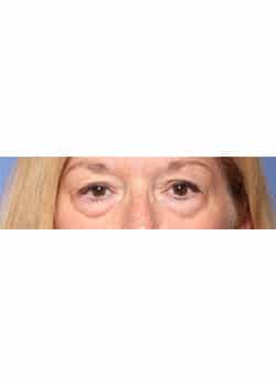 Before Image: Eyelid Lift - other