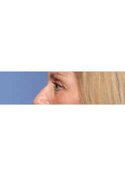 After Image: Eyelid Lift - other