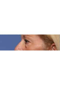Before Image: Eyelid Lift - other