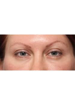 After Image: Eyelid Lift - front