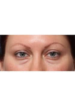 Before Image: Eyelid Lift - front