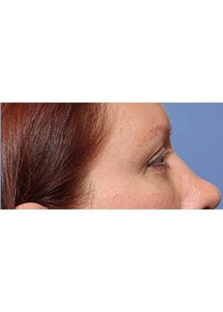 After Image: Eyelid Lift - other