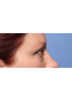 Before Image: Eyelid Lift - other