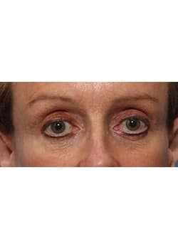 After Image: Eyelid Lift - other