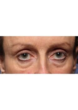Before Image: Eyelid Lift - other
