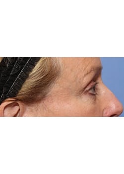 After Image: Eyelid Lift - other