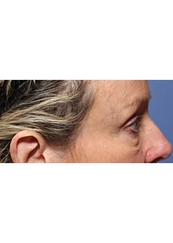 Before Image: Eyelid Lift - other