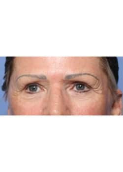 After Image: Eyelid Lift - other