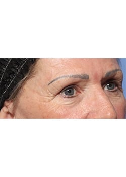 After Image: Eyelid Lift - right-front-oblique
