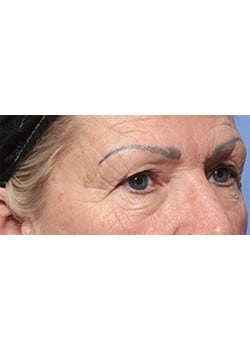 Before Image: Eyelid Lift - right-front-oblique