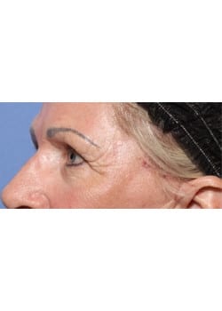 After Image: Eyelid Lift - left-front-oblique