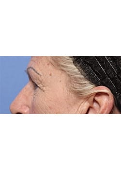 Before Image: Eyelid Lift - left-front-oblique