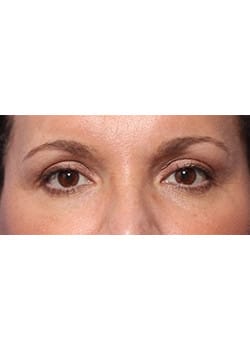 After Image: Eyelid Lift - front