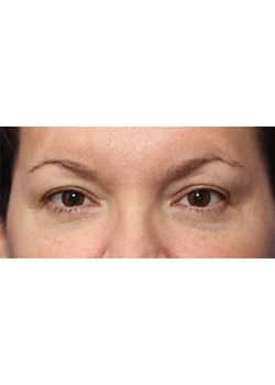 Before Image: Eyelid Lift - front