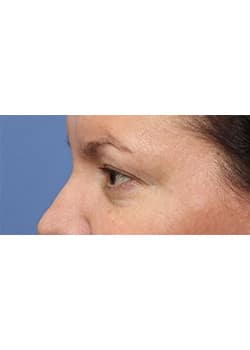 Eyelid Lift