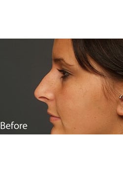 Before Image: Nose Reshaping - other