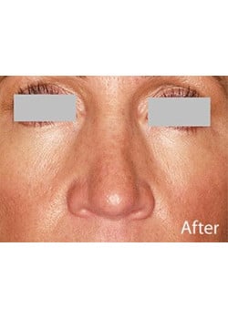 Nose Reshaping