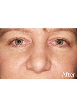 Nose Reshaping