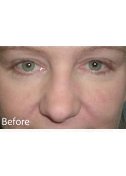 Nose Reshaping