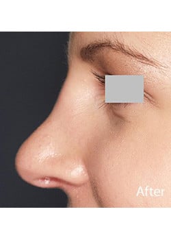 Nose Reshaping