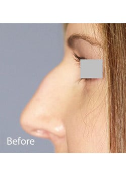 Nose Reshaping