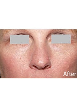 Nose Reshaping